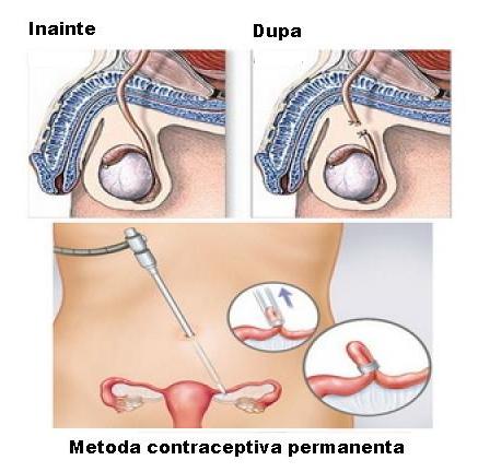 Metode contraceptive Contraceptia permanenta